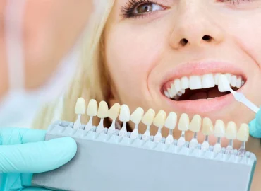 لمینت بهتره یا کامپوزیت؟