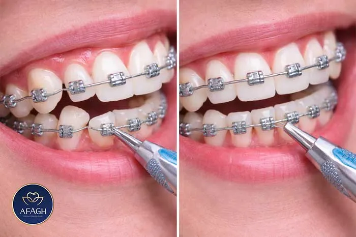 اصلاح نامرتبی دندان با ارتودنسی در فرشته