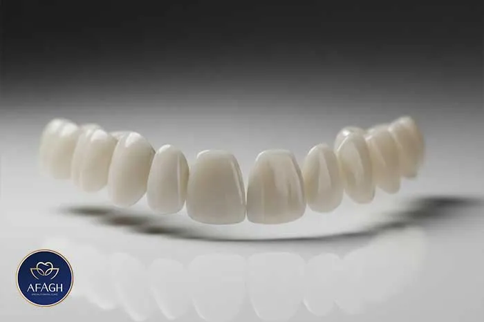 لمینت سرامیکی دندان در الهیه تهران