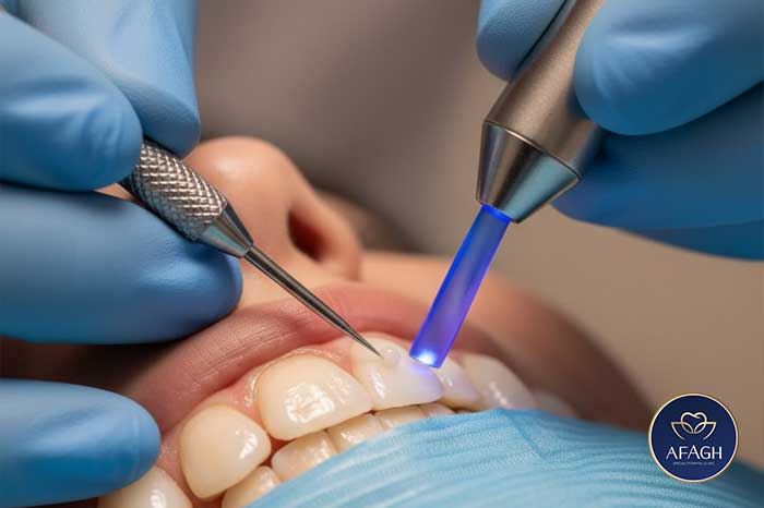 اجرای کامپوزیت ونیر در کلینیک آفاق فرشته