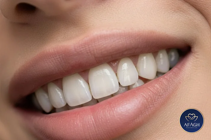 روکش ایمپلنت دندان در فرشته تهران