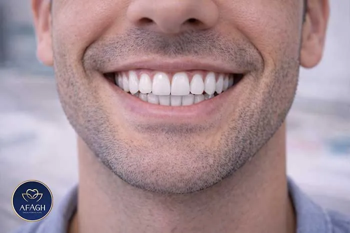 نتیجه طبیعی درمان ارتودنسی دندان در فرشته