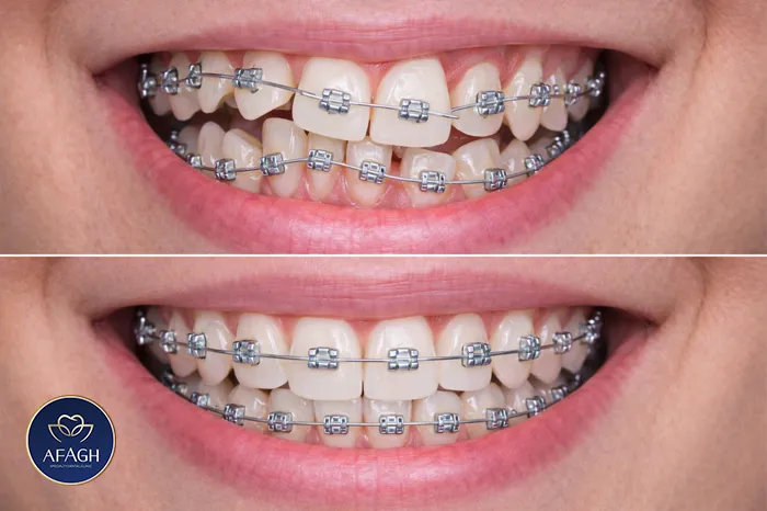 نتیجه طبیعی ارتودنسی دندان انجام‌شده در الهیه
